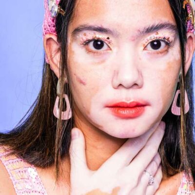 While both vitiligo and albinism involve the loss of skin pigmentation, they have distinct causes and symptoms. - Vitilox for Vitiligo Treatment Vitiligo and Albinism