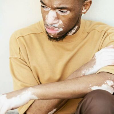 It occurs when the melanocytes, the cells responsible for producing melanin, are destroyed. - Vitilox for Vitiligo Treatment Vitiligo and Albinism