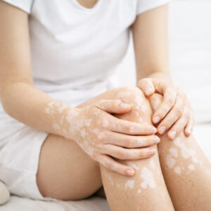 Vitiligo Joint Areas