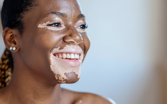 The contrast is more visible, the emotional weight can be heavier - Vitilox for Vitiligo Treatment Vitiligo in Darker Skin Tones
