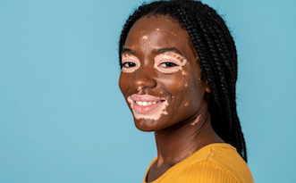 Vitiligo in Darker Skin Tones